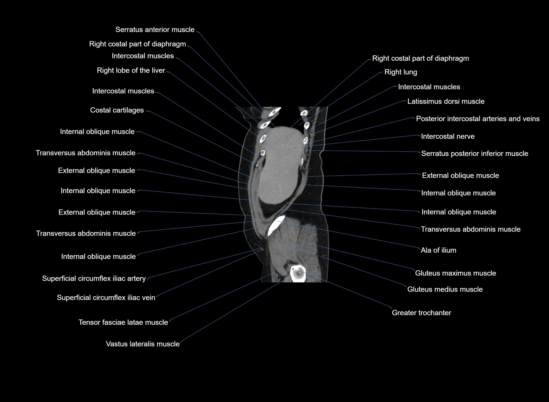 CT Abdomen sagittal cross sectional anatomy labelled radiology image -00099.webp